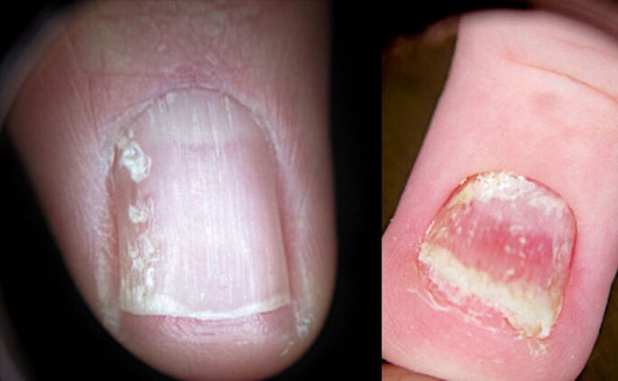 psoriasis-des-ongles-sur-les-mains-et-les-pieds-causes-diagnostic-et